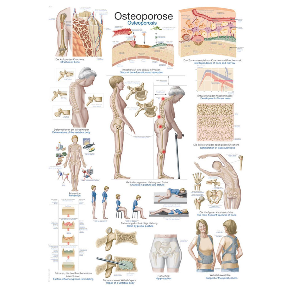 Erler-Zimmer Anatomische Lehrtafel "Osteoporose"