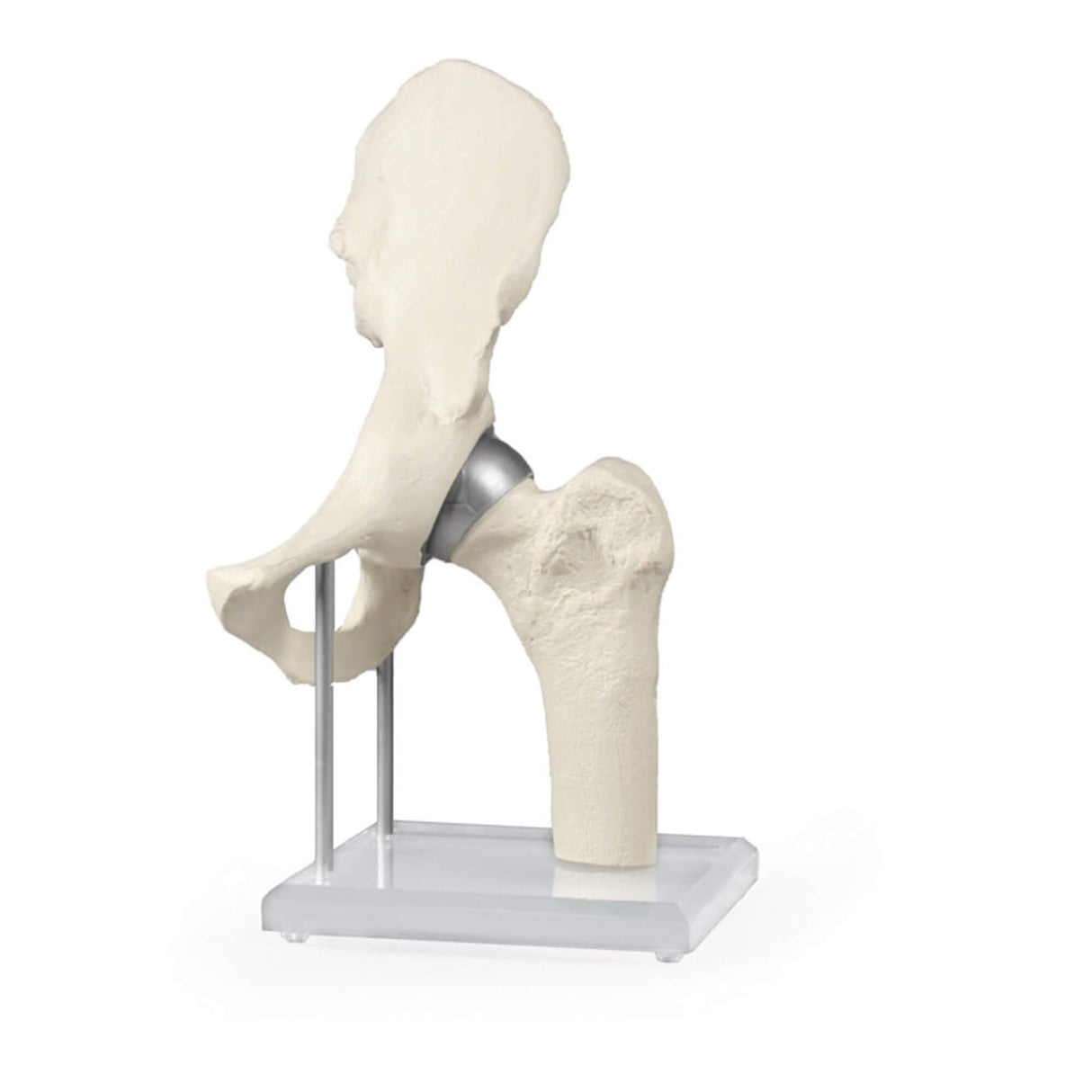 Erler-Zimmer Hüftgelenk mit Schalenprothese