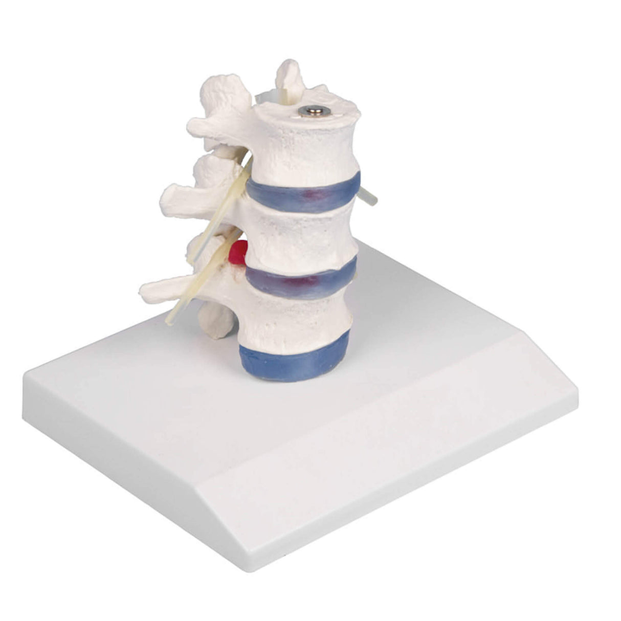 Erler-Zimmer Lendenwirbel Modell mit Bandscheibenvorfall und Stativ