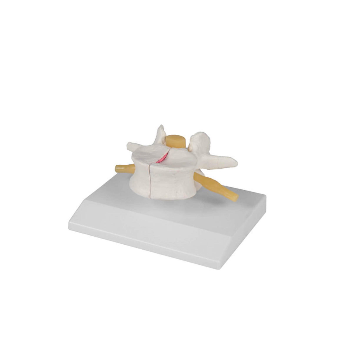 Erler-Zimmer Wirbel Modell Osteoporose 2fach vergrößert