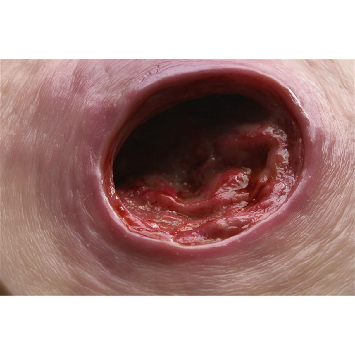 Erler-Zimmer Dekubitus tief Tischmodell im Rahmen