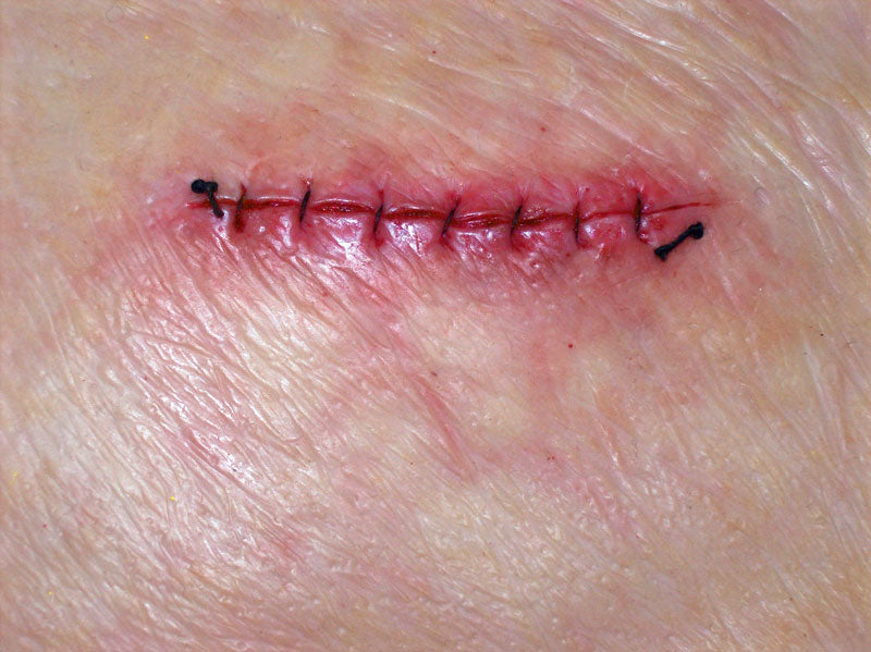 Erler-Zimmer OP Wunde Modell frisch vernäht