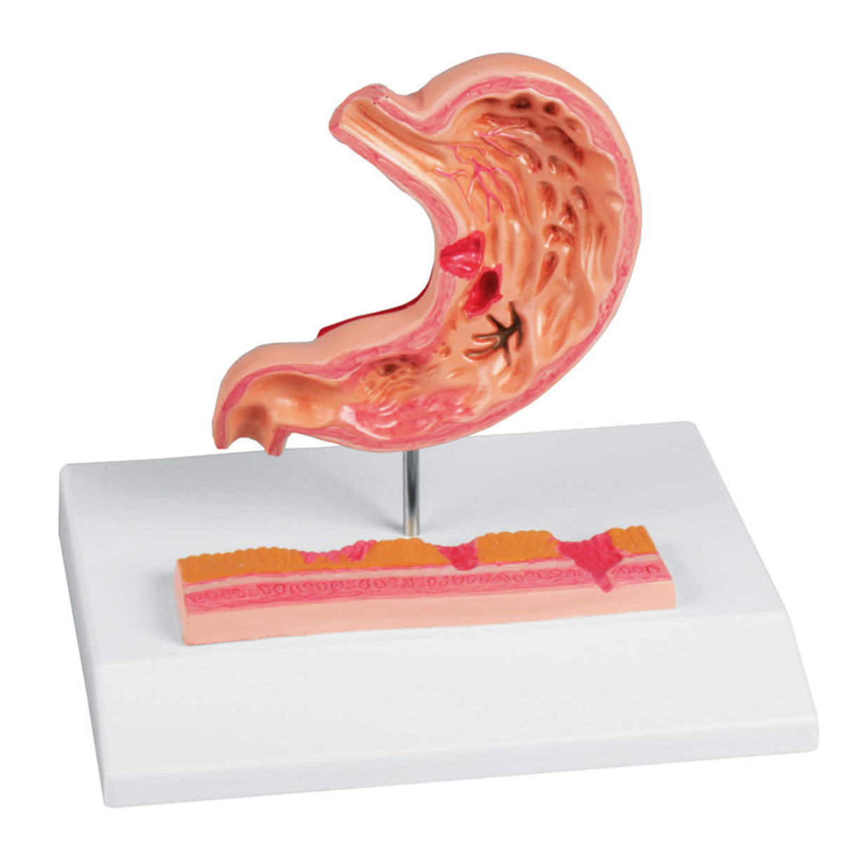Erler-Zimmer Magen Modell mit Magengeschwüren
