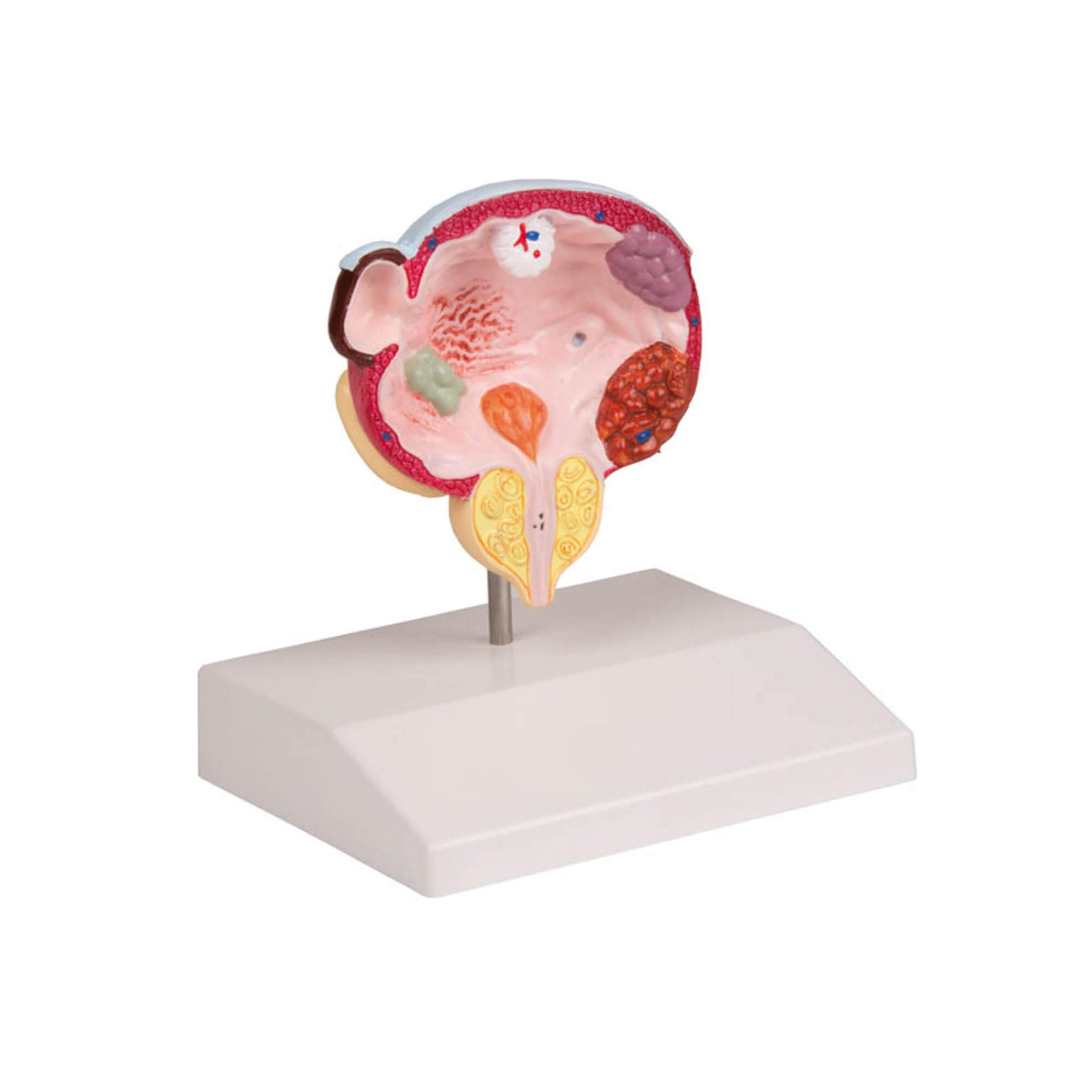 Erler-Zimmer Erkrankungen Modell von Blase und Prostata