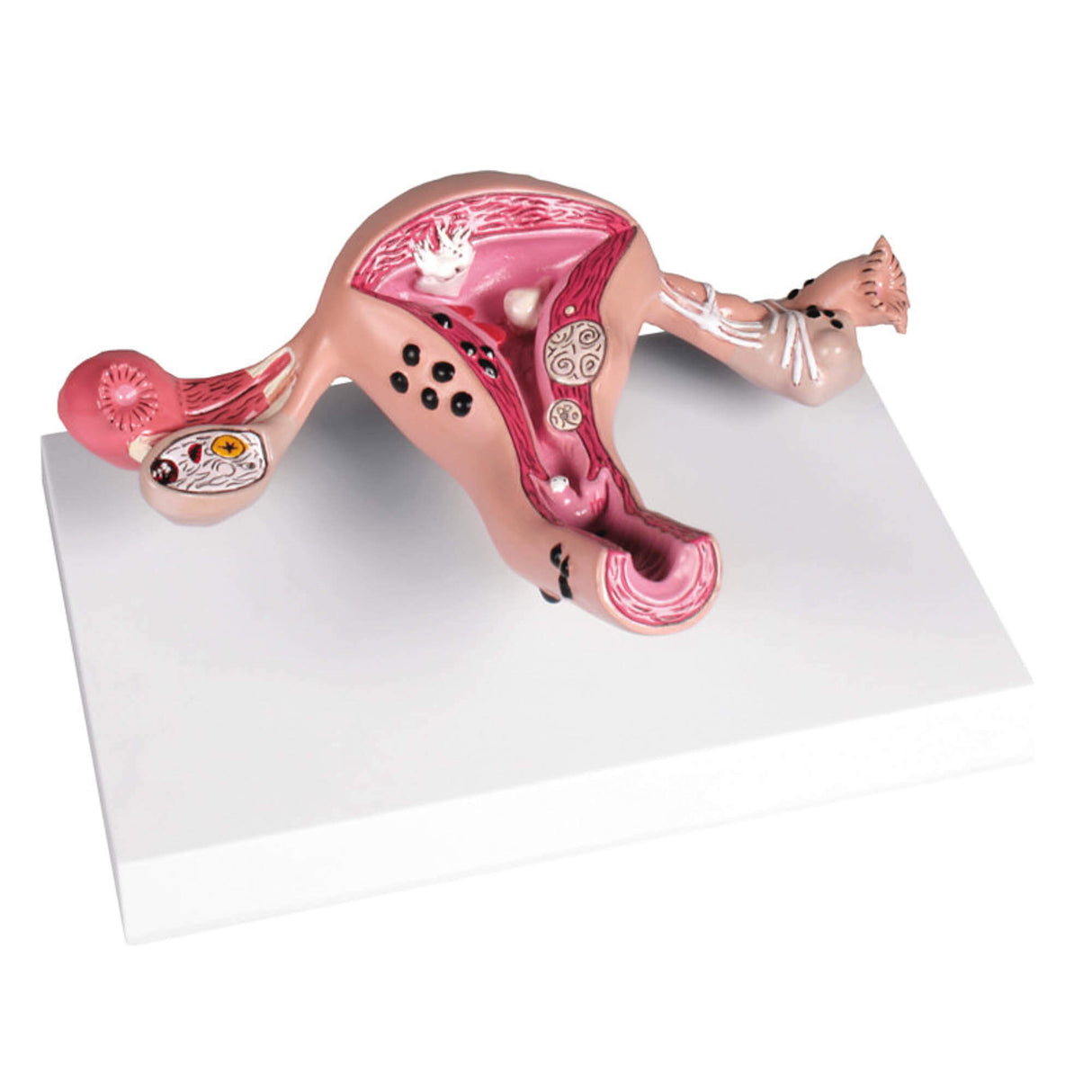 Erler-Zimmer Uterusmodell mit Erkrankungen