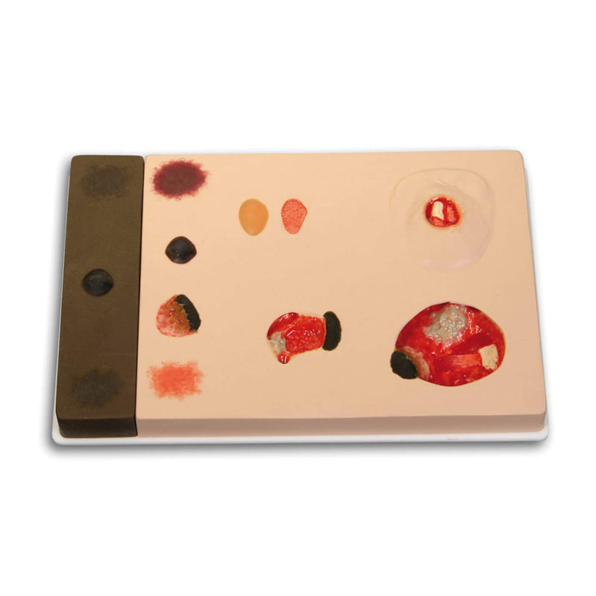 Erler-Zimmer Pat Druckgeschwür Klassifizierungsmodell