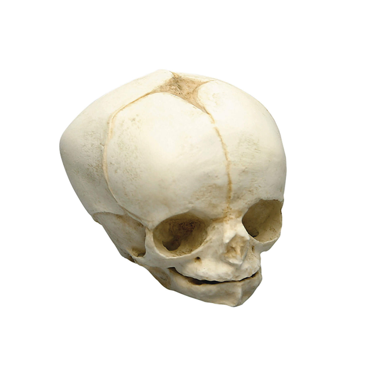 Erler-Zimmer Fetusschädel