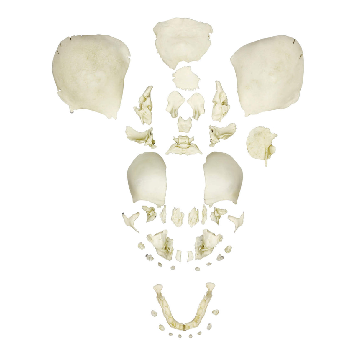 Erler-Zimmer Gesprengter menschlicher Fötusschädel, voll entwickelt