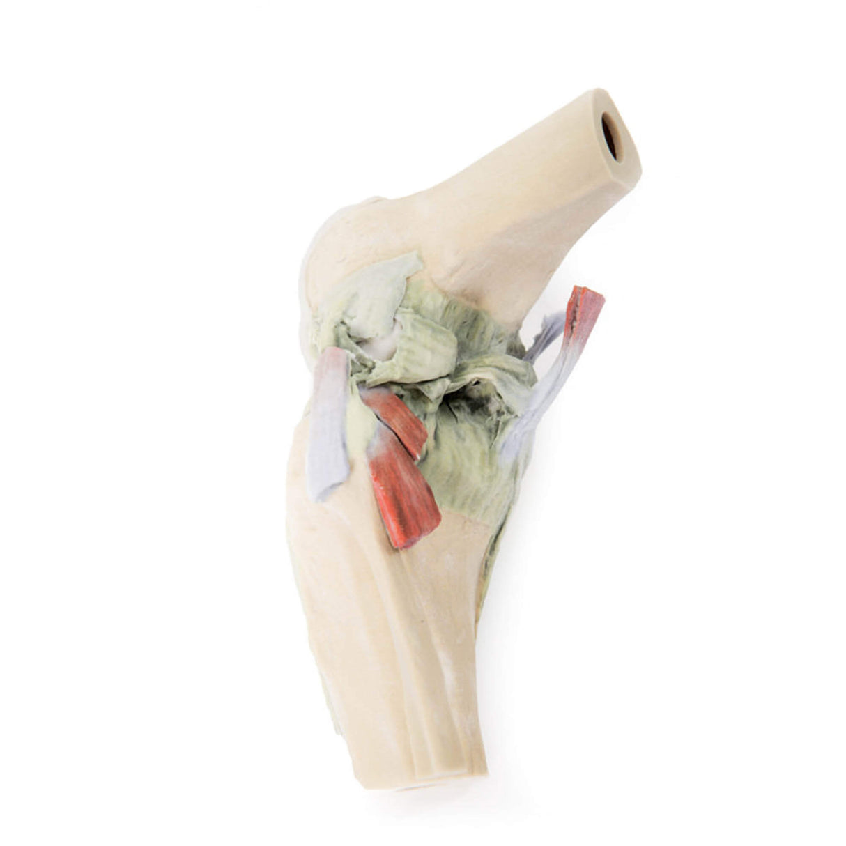 Erler-Zimmer Kniegelenk, gebeugt