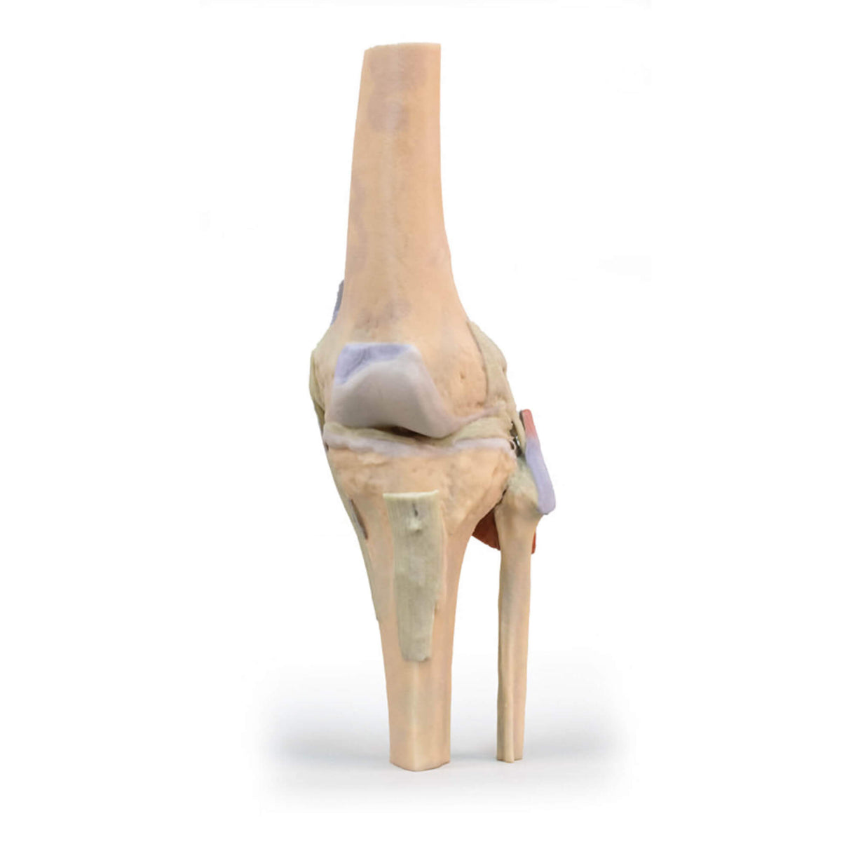 Erler-Zimmer Kniegelenk, gestreckt