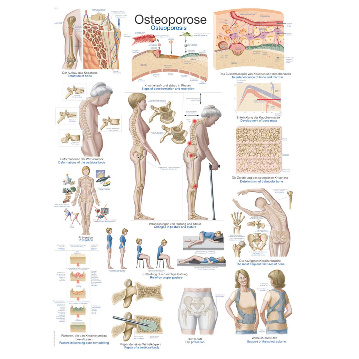 Erler-Zimmer Lehrtafel "Osteoporose"