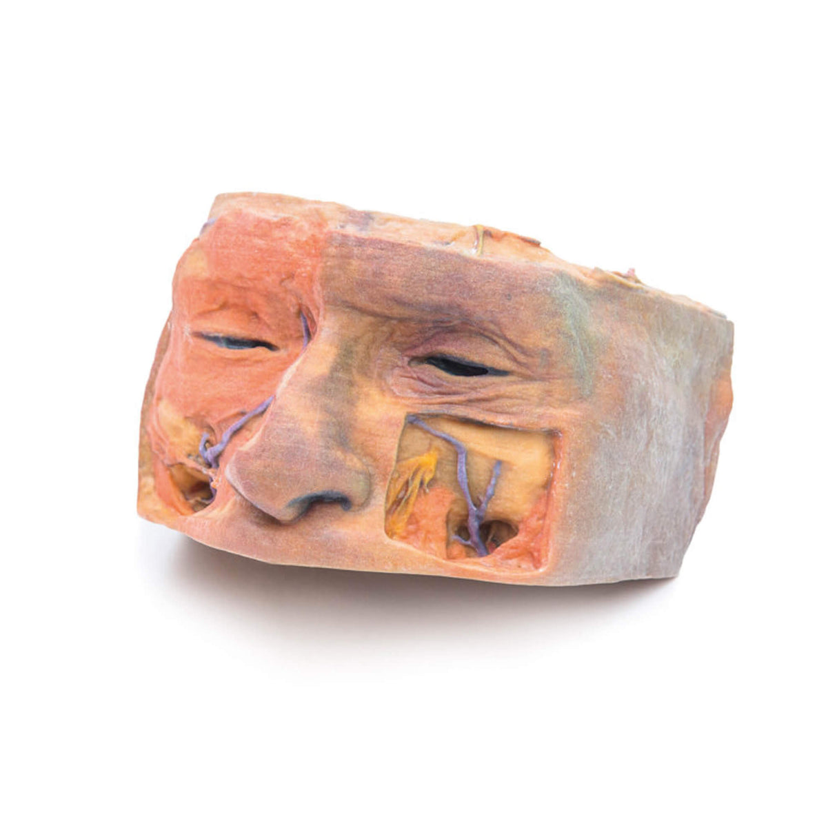 Erler-Zimmer Obere Orbita