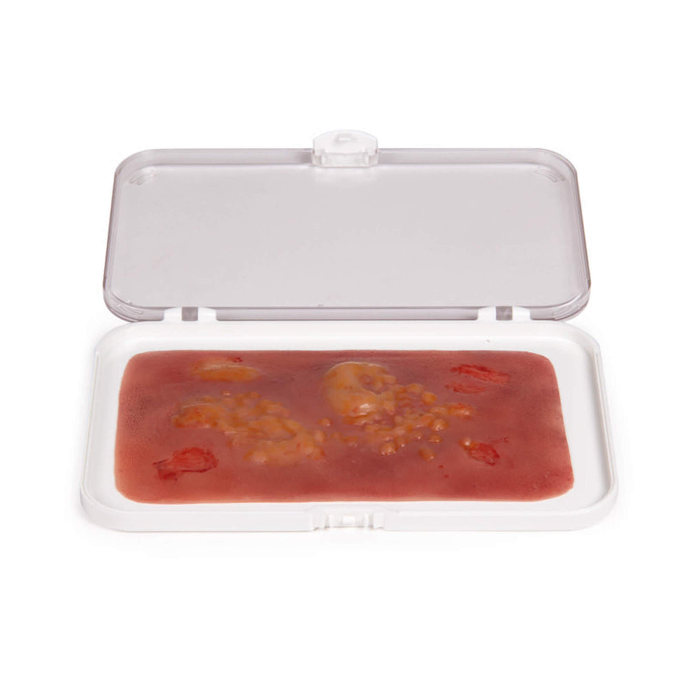 Erler-Zimmer Wundmoulage Brandwunde
