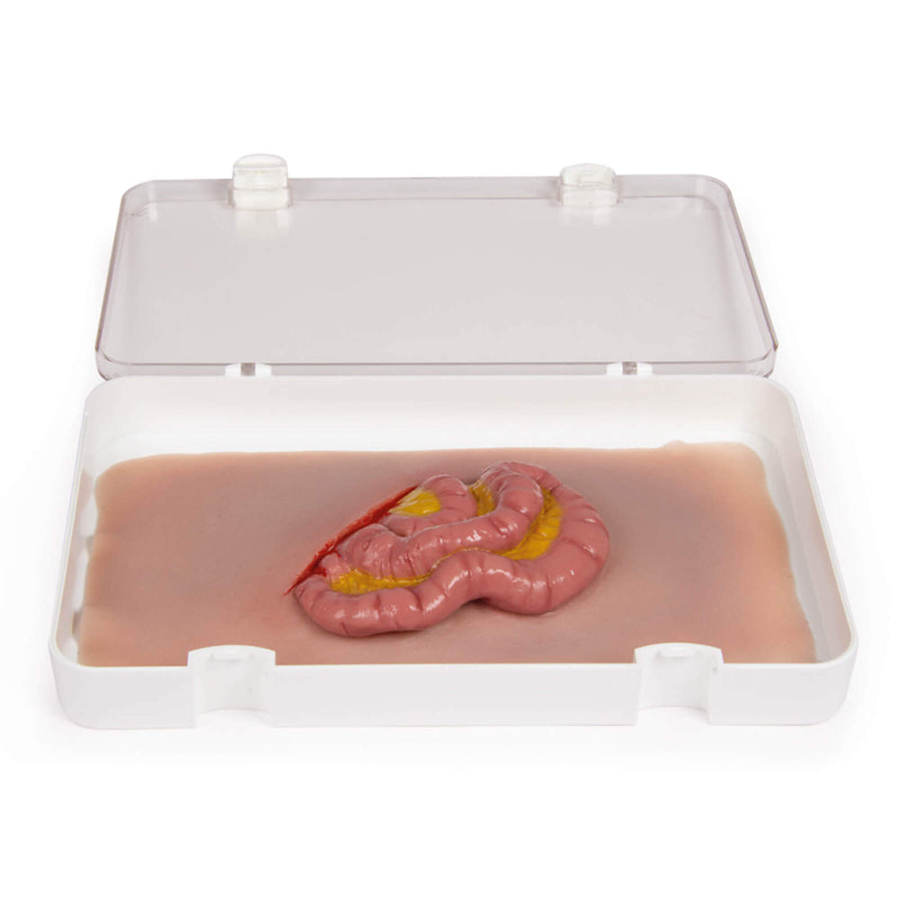 Erler-Zimmer Wundmoulage Dünndarmaustritt