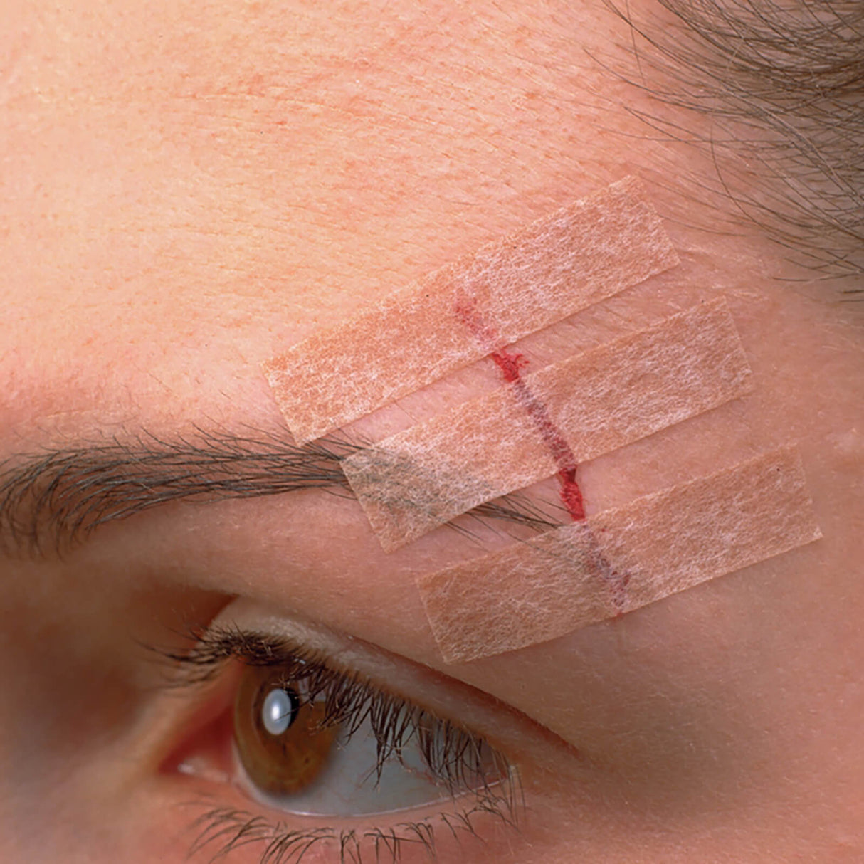 3M Steri-Strip 12 x 100 mm, Wundverschlussstreifen (12 x 6 Str.)