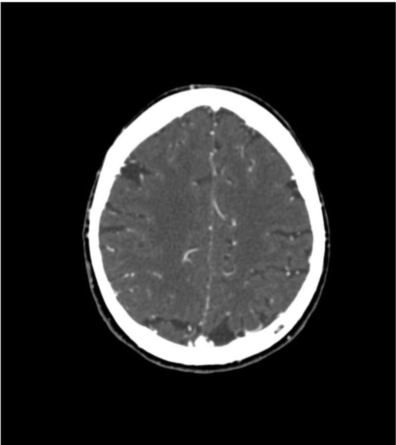 Erler-Zimmer Kopf und Hals Phantom für CT, Röntgen und Strahlentherapie