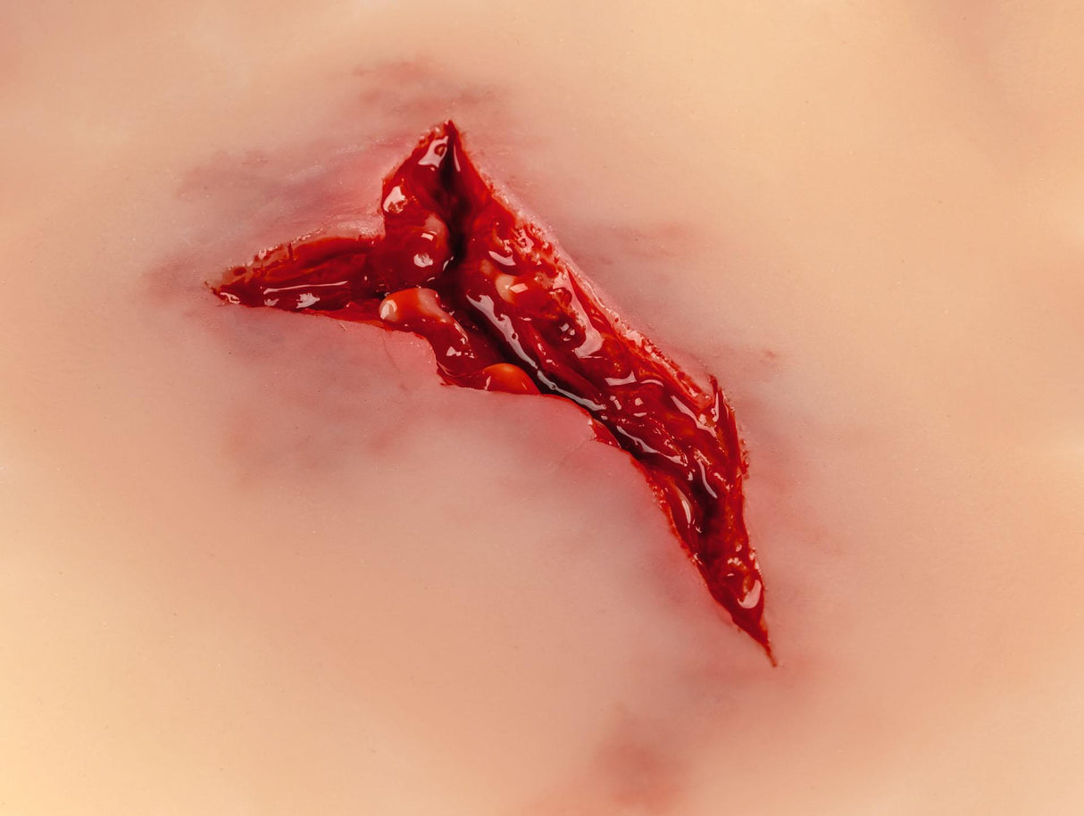 Erler-Zimmer Wundmoulage Risswunde