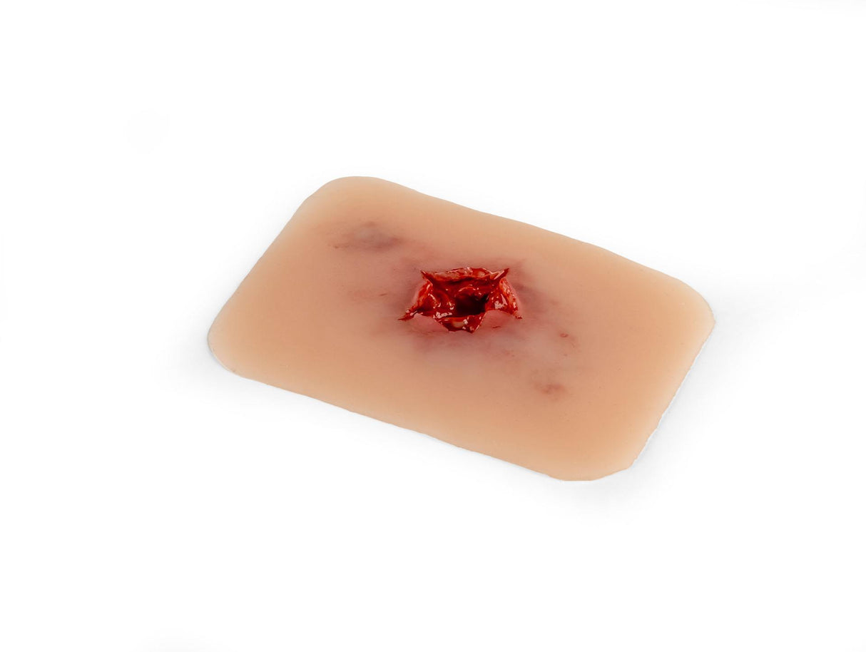 Erler-Zimmer Wundmoulage Schuß Austrittswunde