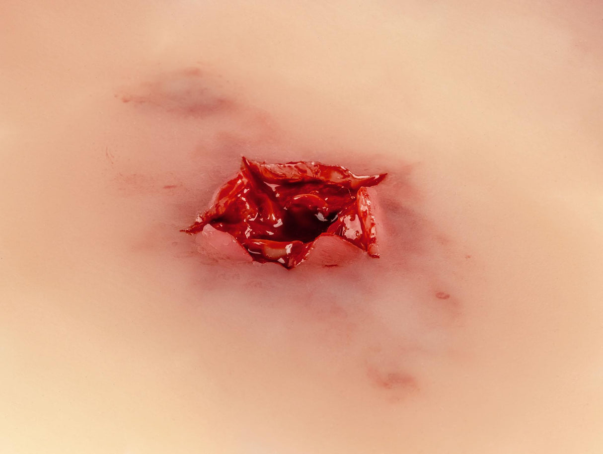 Erler-Zimmer Wundmoulage Schuß Austrittswunde