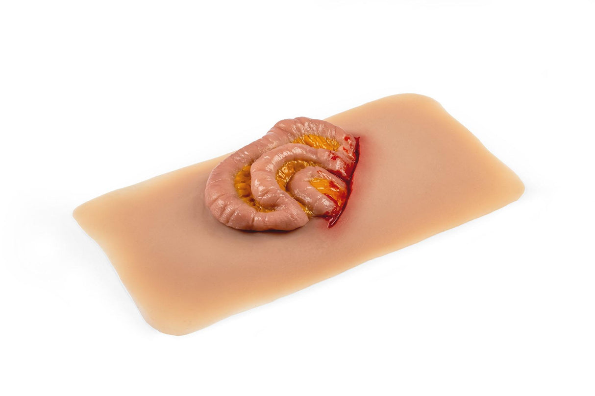 Erler-Zimmer Wundmoulage Dünndarmaustritt
