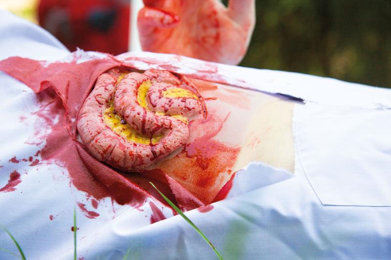 Erler-Zimmer Wundmoulage Dünndarmaustritt