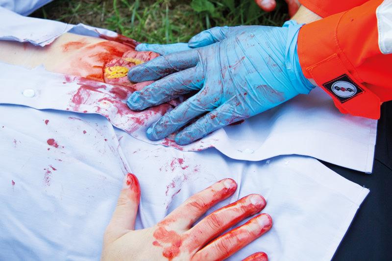 Erler-Zimmer Wundmoulage Dünndarmaustritt
