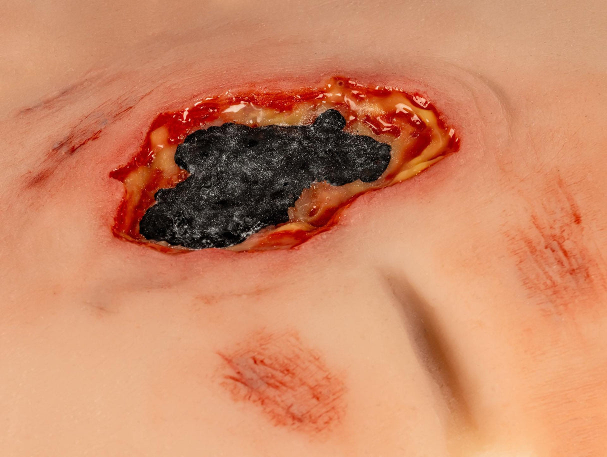 Erler-Zimmer Wundmoulage sakraler Dekubitus, gesäubert