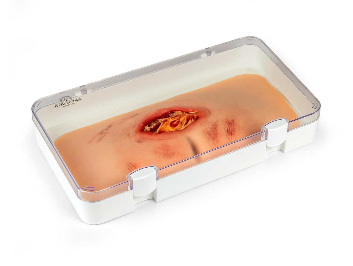 Erler-Zimmer Wundmoulage sakraler Dekubitus, gesäubert