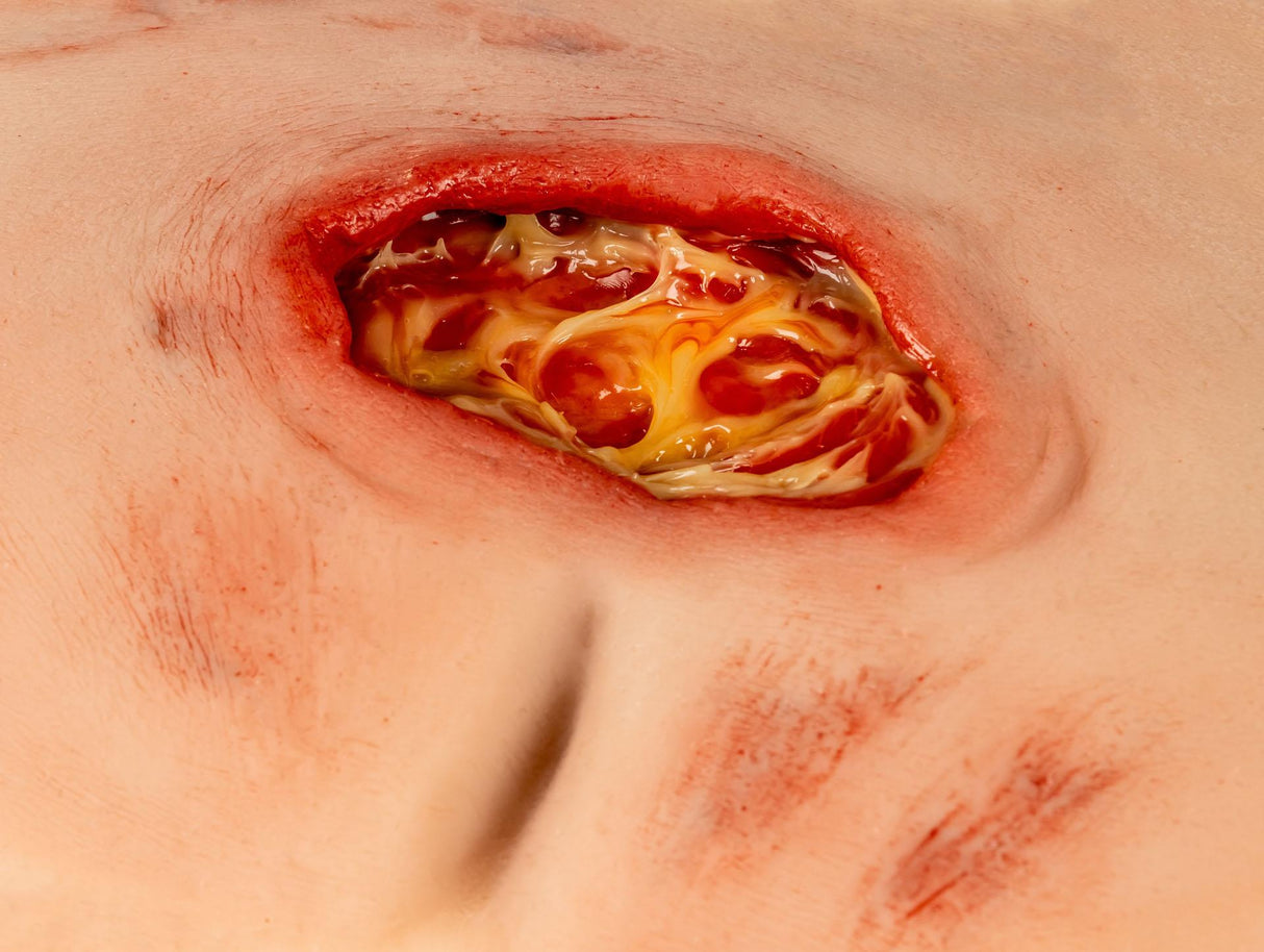 Erler-Zimmer Wundmoulage sakraler Dekubitus, gesäubert