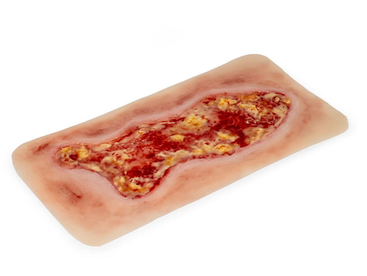 Erler-Zimmer Wundmoulage Ulcus Cruris Venosum, groß, Epithelisierungsphase