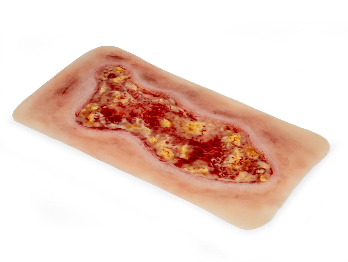 Erler-Zimmer Wundmoulage Ulcus Cruris Venosum, groß, Epithelisierungsphase