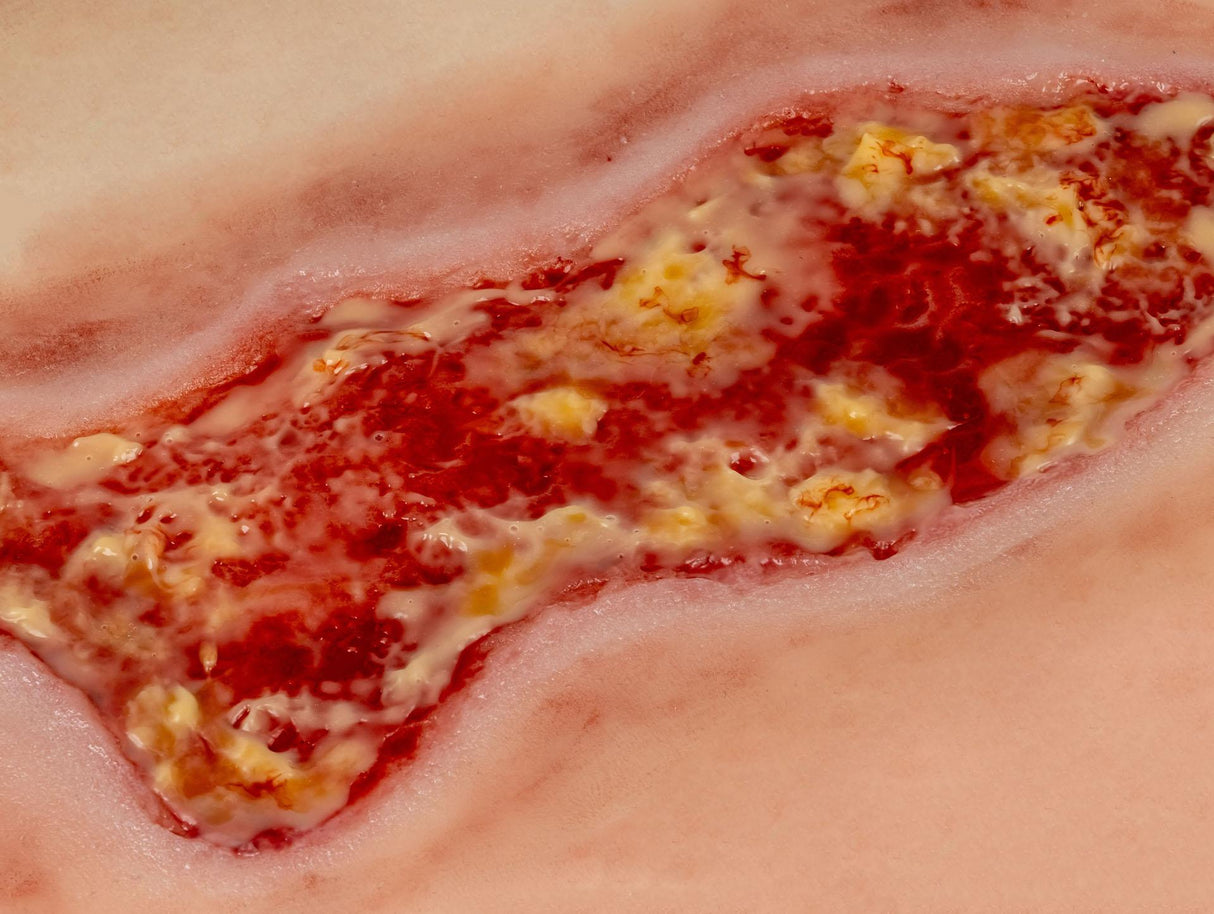 Erler-Zimmer Wundmoulage Ulcus Cruris Venosum, groß, Epithelisierungsphase