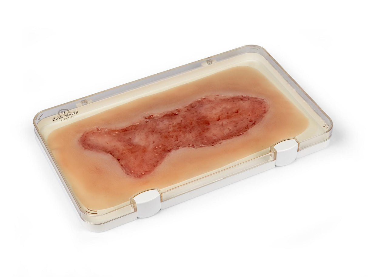 Erler-Zimmer Wundmoulage Ulcus Cruris Venosum, groß, Epithelisierungsphase