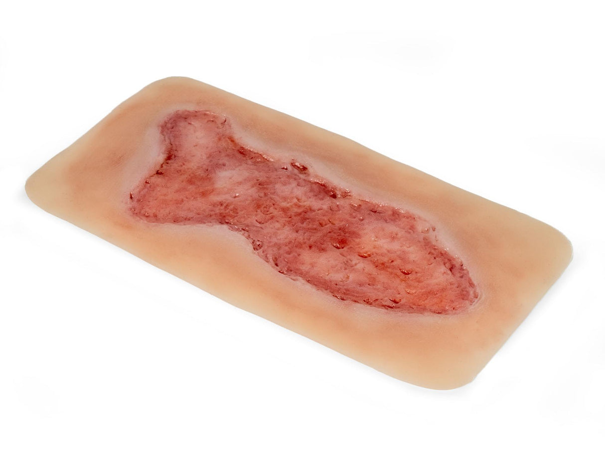 Erler-Zimmer Wundmoulage Ulcus Cruris Venosum, groß, Epithelisierungsphase