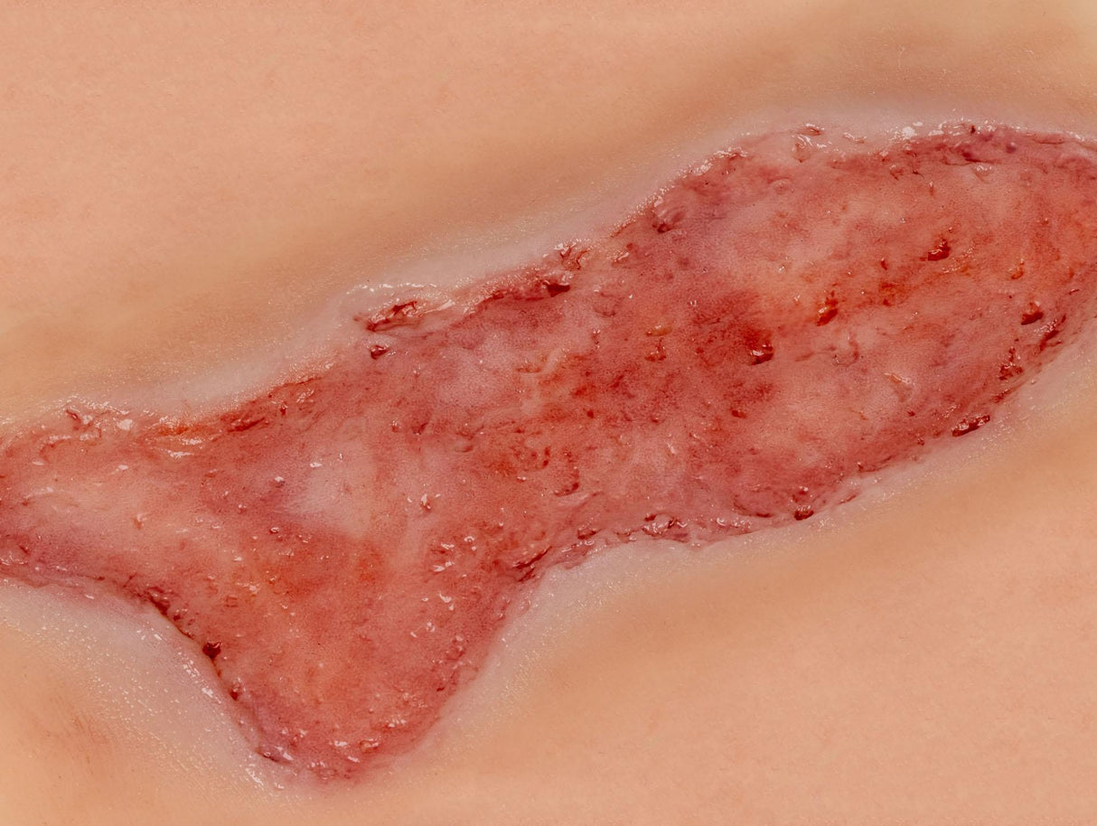 Erler-Zimmer Wundmoulage Ulcus Cruris Venosum, groß, Epithelisierungsphase