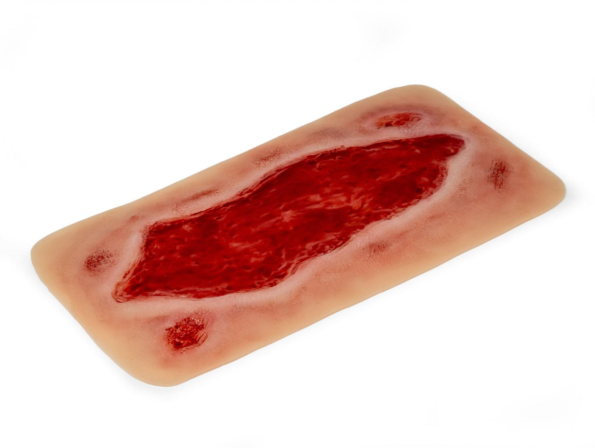 Erler-Zimmer Wundmoulage Ulcus Cruris Arteriosum, groß, Epithelisierungsphase