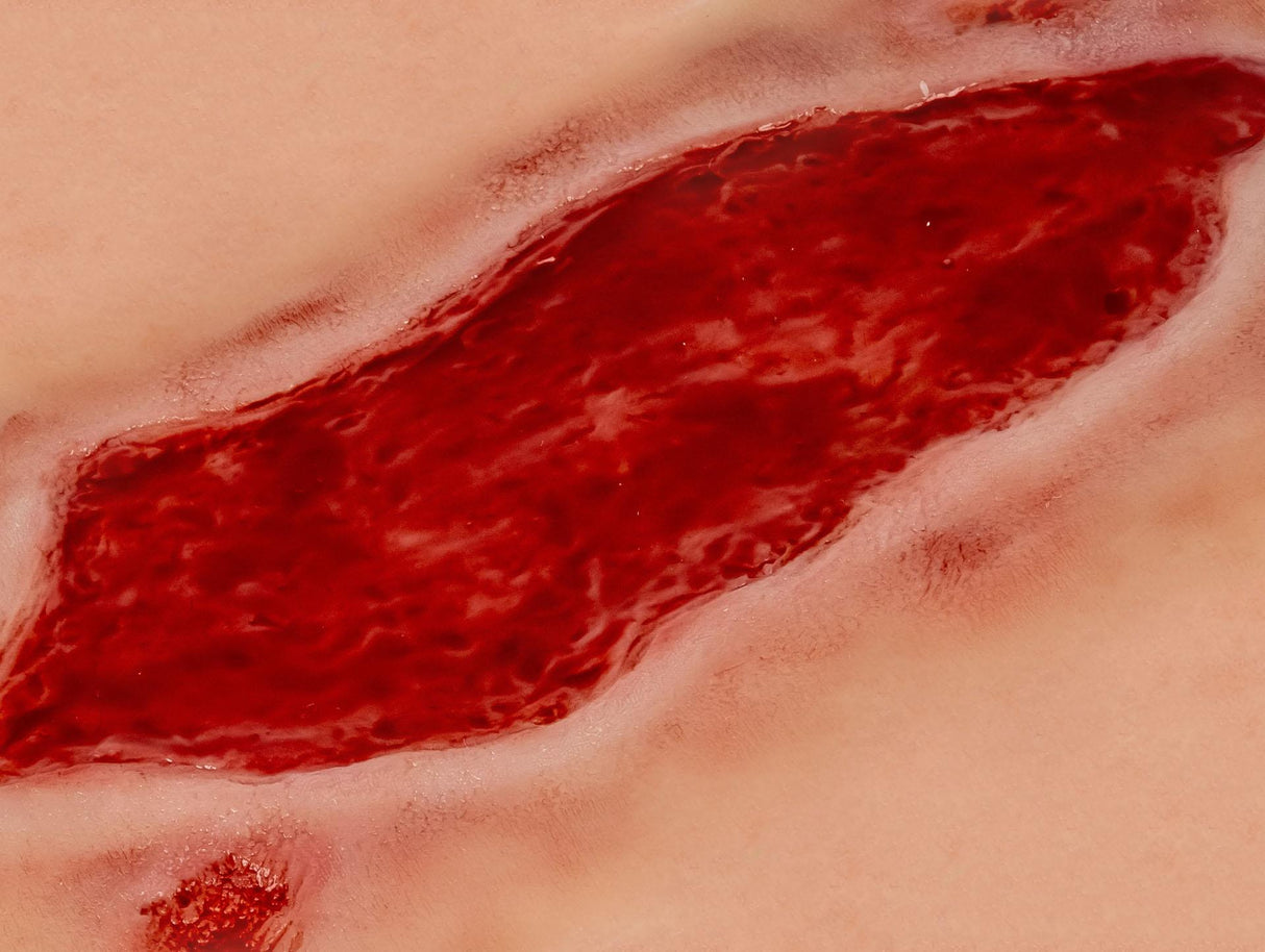 Erler-Zimmer Wundmoulage Ulcus Cruris Arteriosum, groß, Epithelisierungsphase