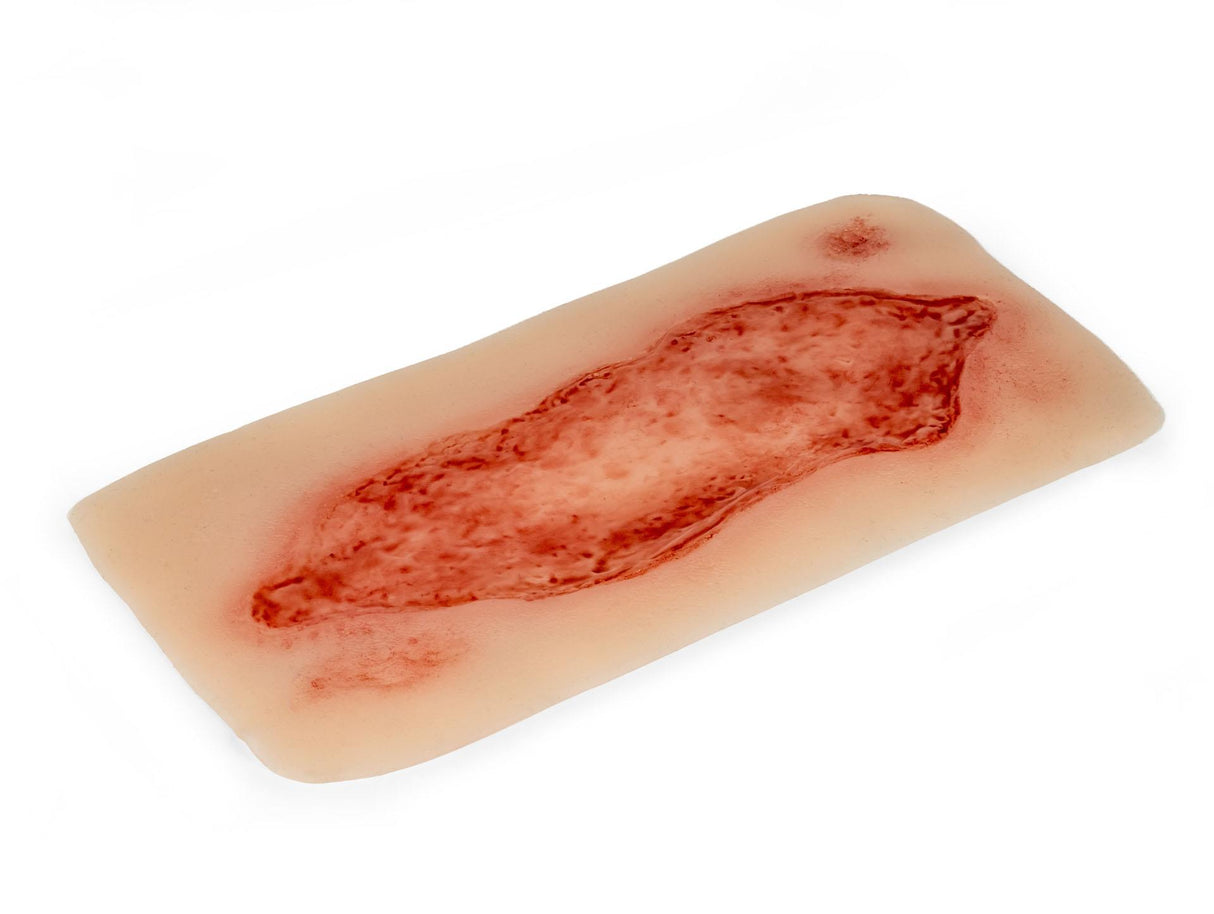 Erler-Zimmer Wundmoulage Ulcus Cruris Arteriosum, groß, Epithelisierungsphase