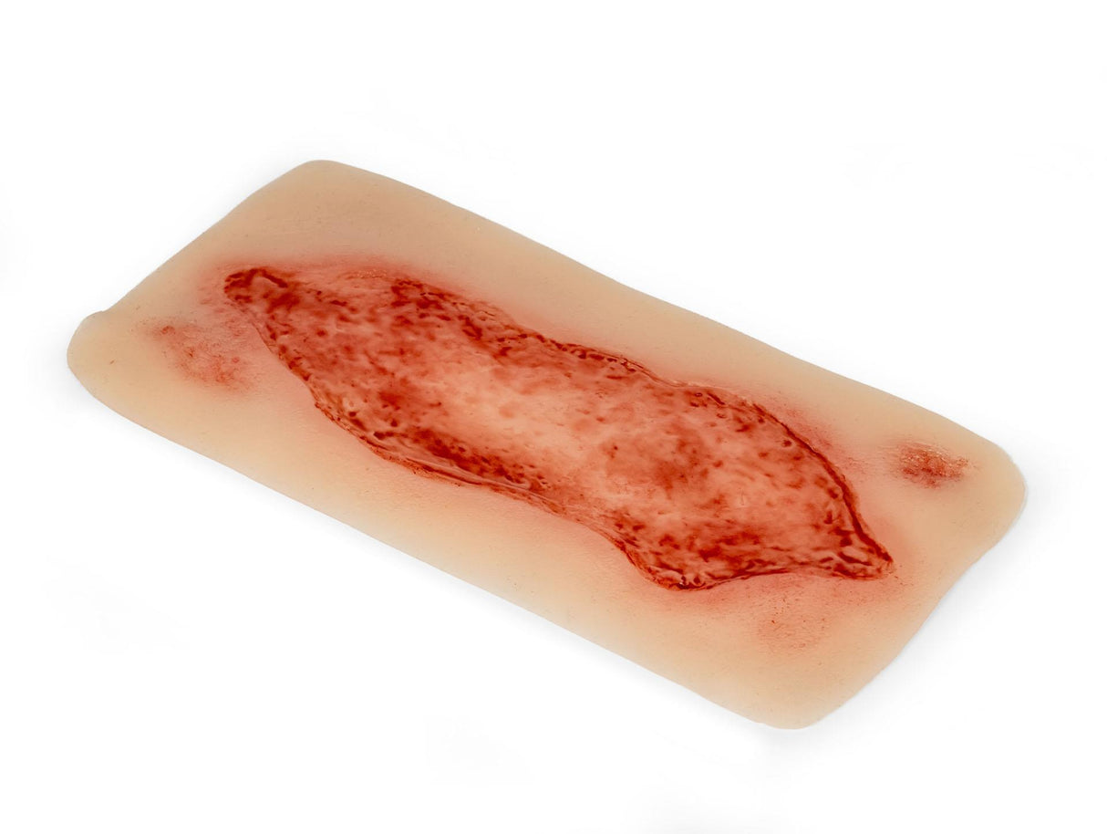 Erler-Zimmer Wundmoulage Ulcus Cruris Arteriosum, groß, Epithelisierungsphase