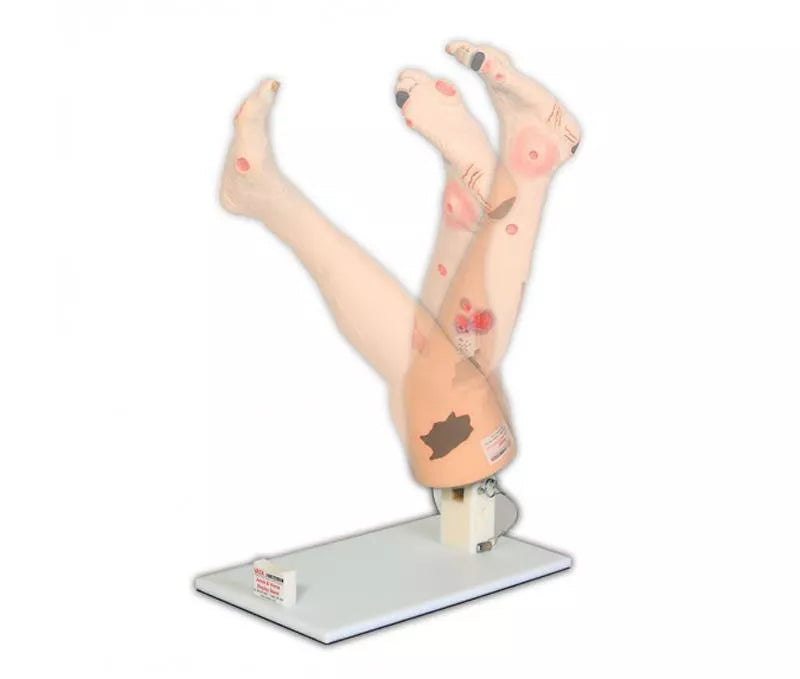 Erler-Zimmer Vinnie, Bein mit venöser Insuffizienz