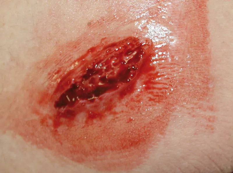 Erler-Zimmer EZ Wounds – Wundensimulation Basic