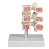 Erler-Zimmer Wirbel Modell Osteoporose 3 Wirbel