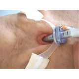Erler-Zimmer Tracheostoma Moulage