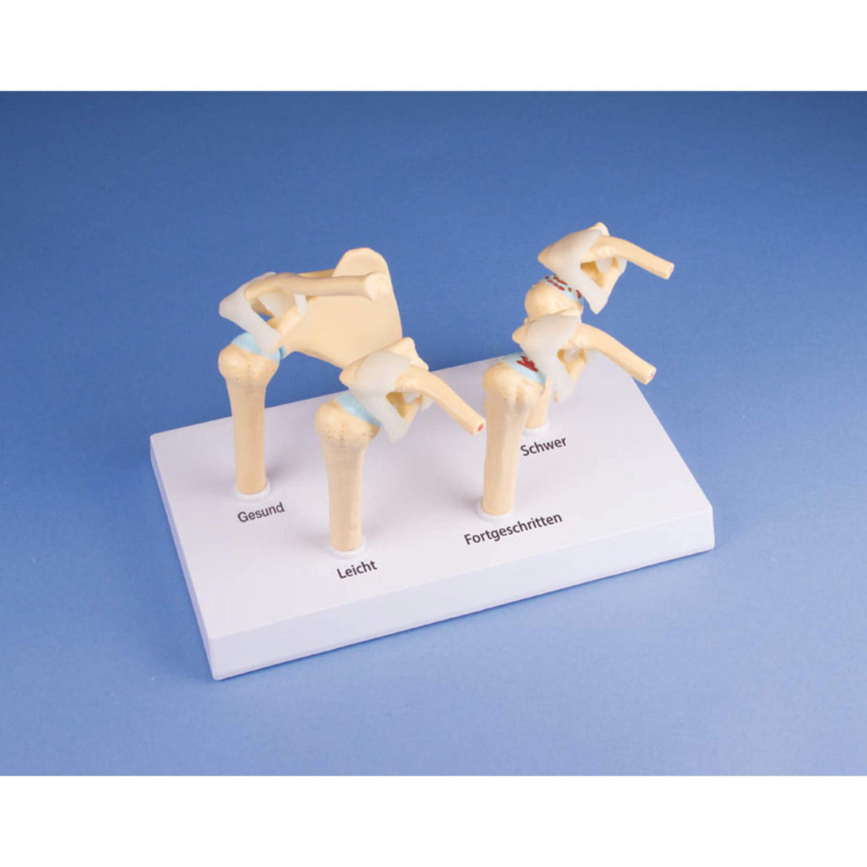 Erler-Zimmer 4 Stadien Osteoarthritis OA Schulter Modell