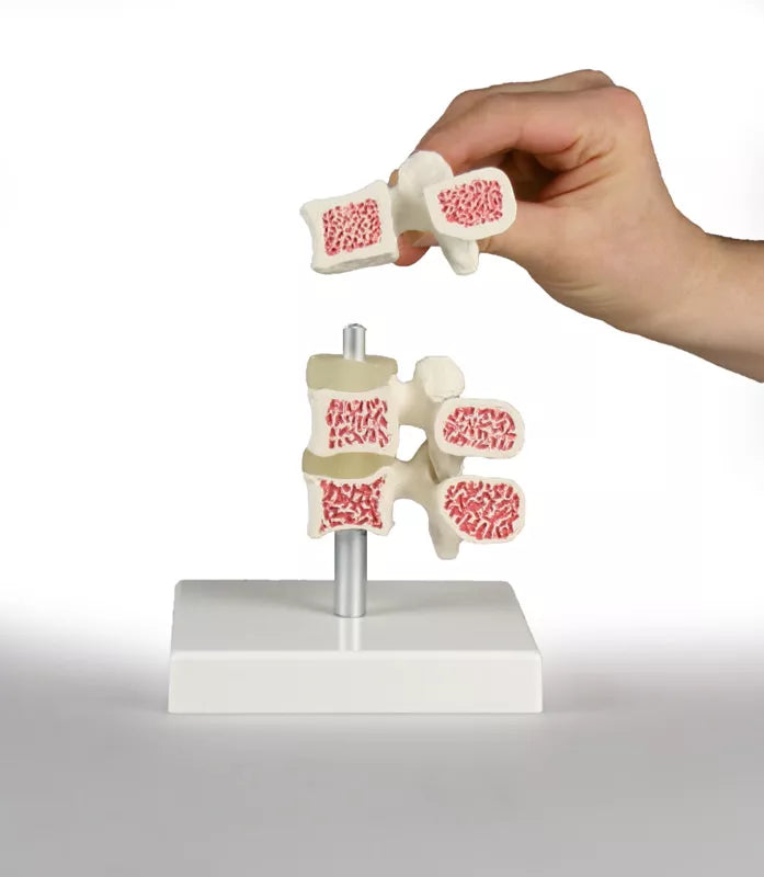Erler-Zimmer Wirbel Modell Osteoporose 3 Wirbel
