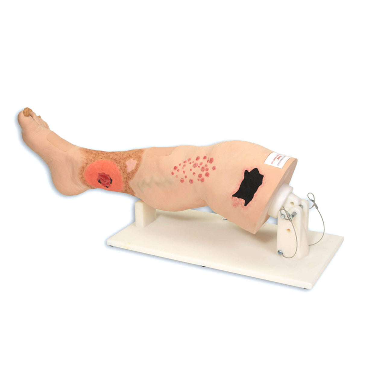 Erler-Zimmer Vinnie, Bein mit venöser Insuffizienz