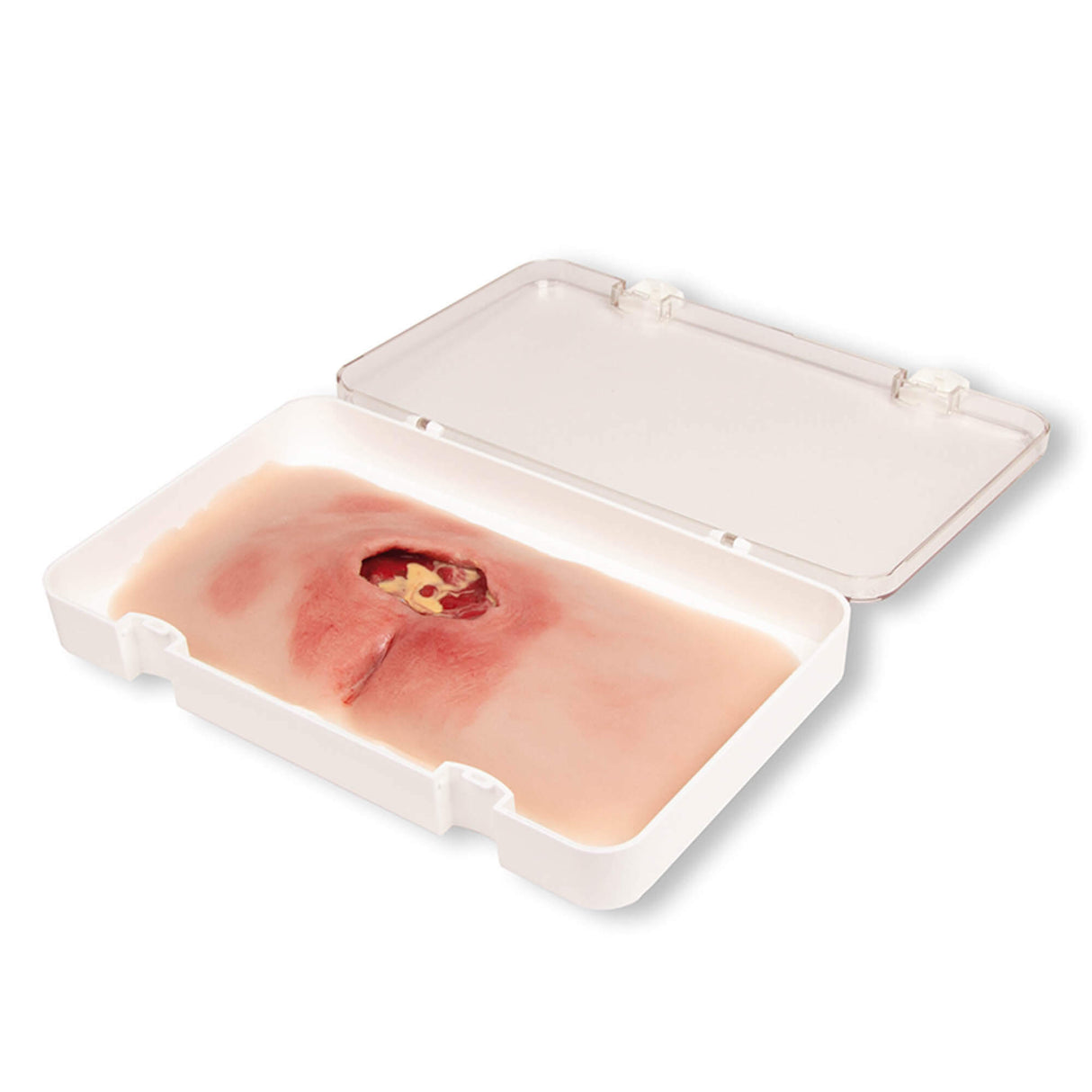 Erler-Zimmer Wundmoulage sakraler Dekubitus