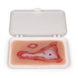 Erler-Zimmer Wundmoulage Verbrühung