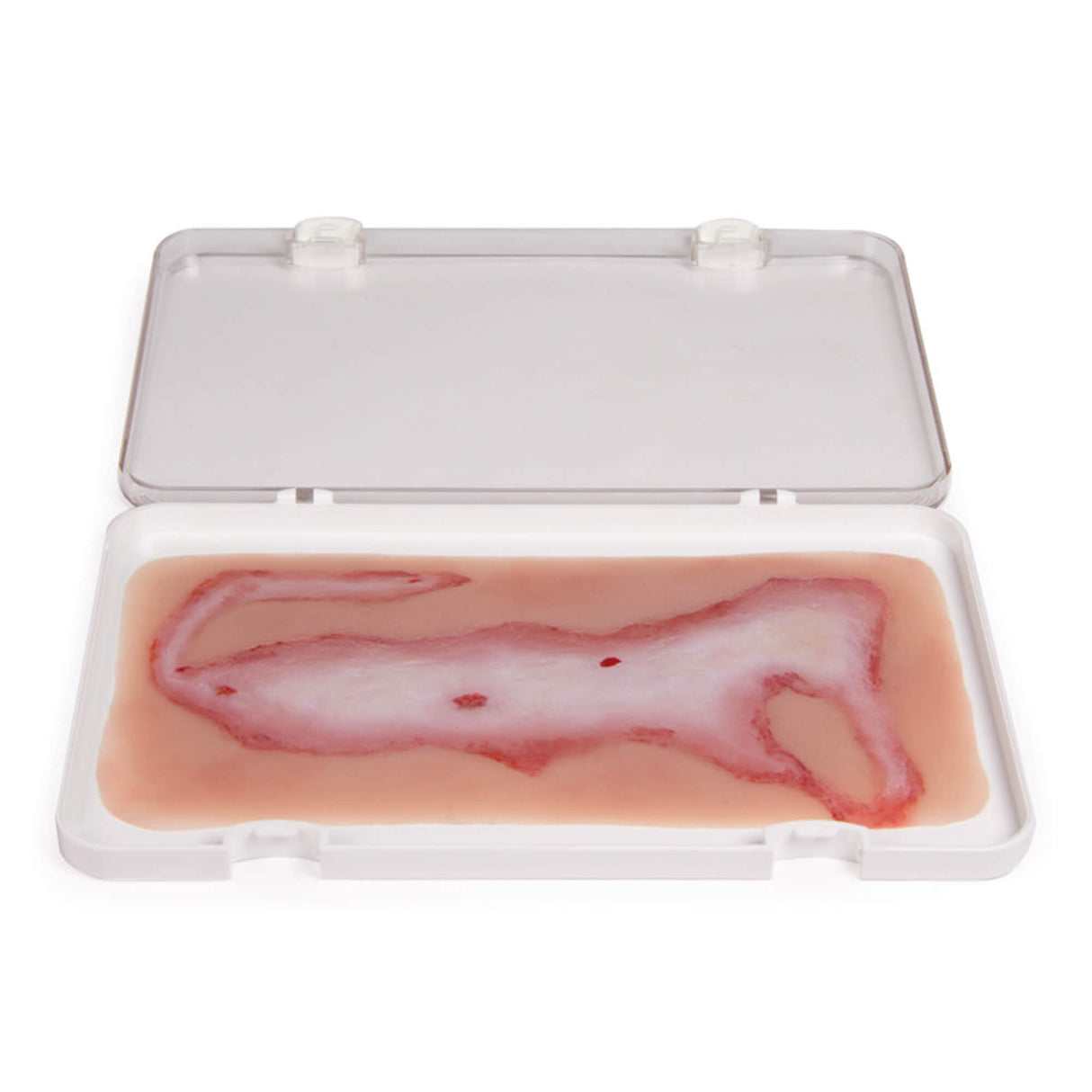 Erler-Zimmer Wundmoulage Verbrühung