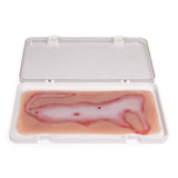 Erler-Zimmer Wundmoulage Verbrühung